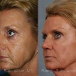 Laser Treatments Before and After Photos in Newburgh, NY, Patient 12820