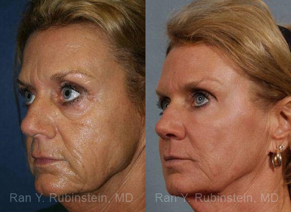 Laser Treatments Before and After Photos in Newburgh, NY, Patient 12820