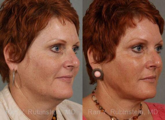 Laser Treatments Before and After Photos in Newburgh, NY, Patient 12823