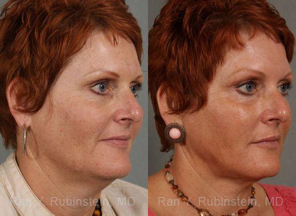 Laser Treatments Before and After Photos in Newburgh, NY, Patient 12823