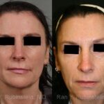 Laser Treatments Before and After Photos in Newburgh, NY, Patient 12839