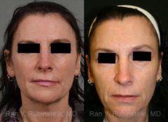 Laser Treatments Before and After Photos in Newburgh, NY, Patient 12839