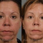 Laser Treatments Before and After Photos in Newburgh, NY, Patient 12847