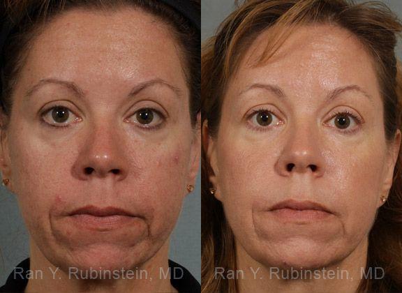 Laser Treatments Before and After Photos in Newburgh, NY, Patient 12847