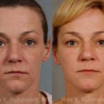 Laser Treatments Before and After Photos in Newburgh, NY, Patient 12860