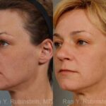 Laser Treatments Before and After Photos in Newburgh, NY, Patient 12860