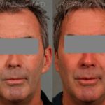 Otoplasty Before and After Photos in Newburgh, NY, Patient 12942