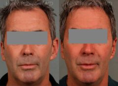 Otoplasty Before and After Photos in Newburgh, NY, Patient 12942