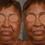 Peels & Microdermabrasion Before and After Photos in Newburgh, NY, Patient 12977