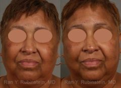 Peels & Microdermabrasion Before and After Photos in Newburgh, NY, Patient 12977