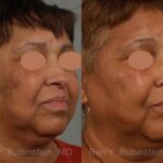 Peels & Microdermabrasion Before and After Photos in Newburgh, NY, Patient 12977