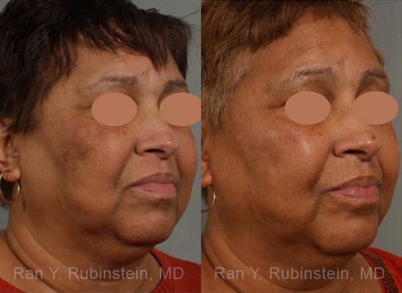 Peels & Microdermabrasion Before and After Photos in Newburgh, NY, Patient 12977