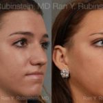 Rhinoplasty Before and After Photos in Newburgh, NY, Patient 13052