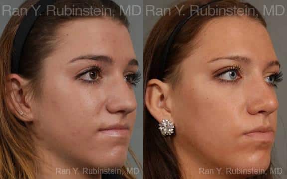 Rhinoplasty Before and After Photos in Newburgh, NY, Patient 13052