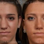 Rhinoplasty Before and After Photos in Newburgh, NY, Patient 13052