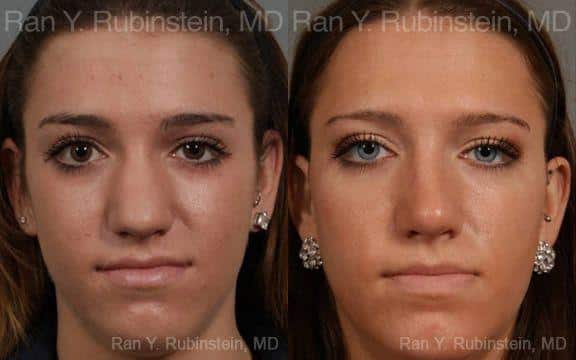 Rhinoplasty Before and After Photos in Newburgh, NY, Patient 13052