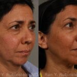 Laser Lift Precision Tx Before and After Photos in Newburgh, NY, Patient 13241