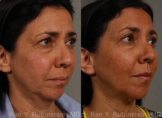 Laser Lift Precision Tx Before and After Photos in Newburgh, NY, Patient 13241