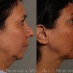 Laser Lift Precision Tx Before and After Photos in Newburgh, NY, Patient 13241