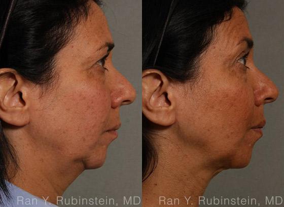 Laser Lift Precision Tx Before and After Photos in Newburgh, NY, Patient 13241