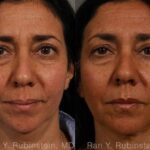 Laser Lift Precision Tx Before and After Photos in Newburgh, NY, Patient 13241