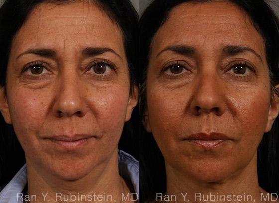 Laser Lift Precision Tx Before and After Photos in Newburgh, NY, Patient 13241