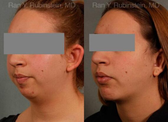 Laser Lift Precision Tx Before and After Photos in Newburgh, NY, Patient 13248