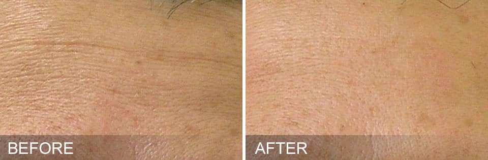 Fine lines – after 1 month Provided by Hydrafacial