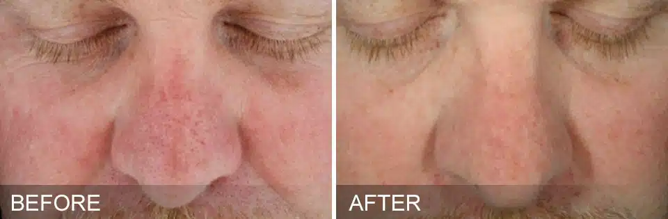 Sun Damage — 3 Sessions (over 2 months) Provided by Hydrafacial