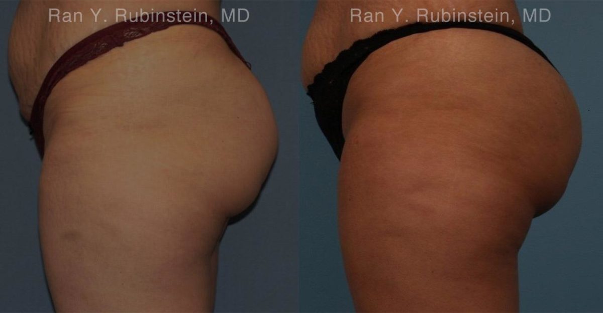 Sculptra Butt Lift Before and After Photos in Newburgh, NY, Patient 16380