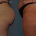 Sculptra Butt Lift Before and After Photos in Newburgh, NY, Patient 16380