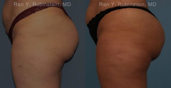 Sculptra Butt Lift Before and After Photos in Newburgh, NY, Patient 16380