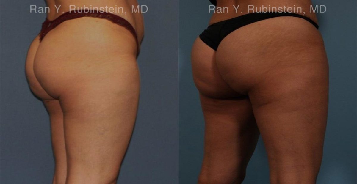 Sculptra Butt Lift Before and After Photos in Newburgh, NY, Patient 16380