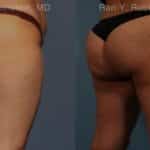 Sculptra Butt Lift Before and After Photos in Newburgh, NY, Patient 16380