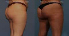 Sculptra Butt Lift Before and After Photos in Newburgh, NY, Patient 16380