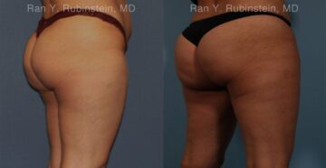Sculptra Butt Lift Before and After Photos in Montvale, NJ, Patient 16380