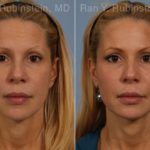 Dermal Fillers Before and After Photos in Newburgh, NY, Patient 16728