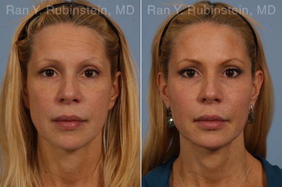 Dermal Fillers Before and After Photos in Newburgh, NY, Patient 16728