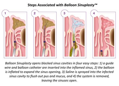 Balloon Sinuplasty in Newburgh NY