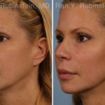 Dermal Fillers Before and After Photos in Newburgh, NY, Patient 16728