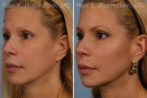 Dermal Fillers Before and After Photos in Newburgh, NY, Patient 16728