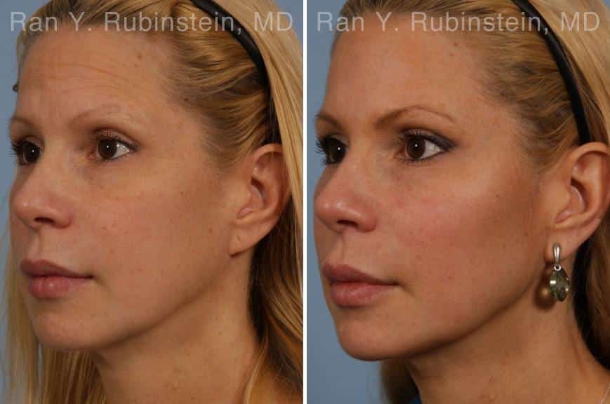 Dermal Fillers Before and After Photos in Newburgh, NY, Patient 16728