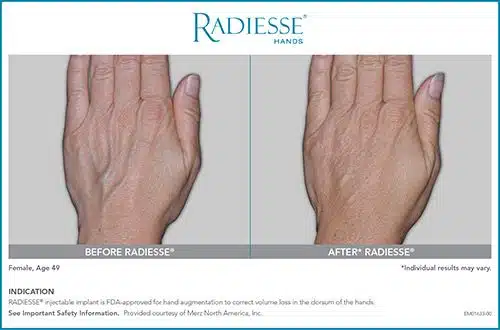 radiesse hands before and after