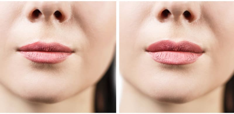 Restylane Silk