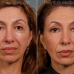 Sculptra Face Before and After Photos in Newburgh, NY, Patient 12747