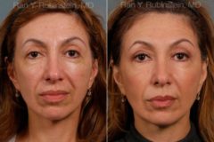 Sculptra Face Before and After Photos in Newburgh, NY, Patient 12747