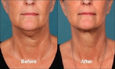 Kybella™ Injectable Before and After Pictures | New York