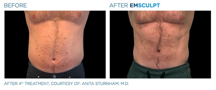 Emsculpt before after