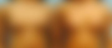 Breast Augmentation Before and After Photos in Montvale, NJ, Patient 12309