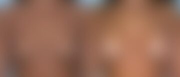 Breast Augmentation Before and After Photos in Montvale, NJ, Patient 12326